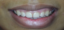 Laser Gummy Smile Correction - Before