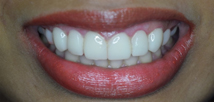 Laser Gummy Smile Correction - After