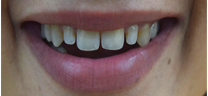 Teeth Gap Closure - Before