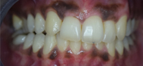 Laser Gums De Pigmentation - Before