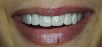 Teeth Gap Closure - After