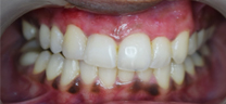 Laser Gums De Pigmentation - After