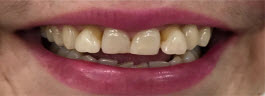 Teeth Alignment Correction with Porcelain Veneers - Before