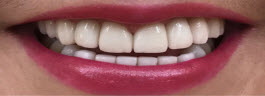 Teeth Alignment Correction with Porcelain Veneers - After