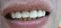 Cosmetic Tooth Colored Fillings - Before