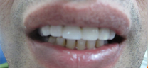 Cosmetic Tooth Colored Fillings - After