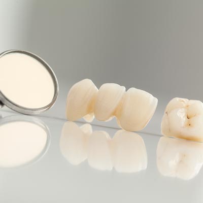 Dental Bridges