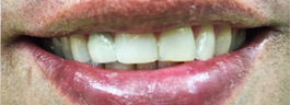 Cosmetic Tooth Colored Fillings - After