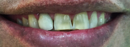 Cosmetic Tooth Colored Fillings - Before