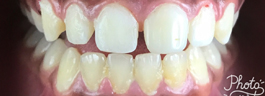 Crooked Tooth Correction - After