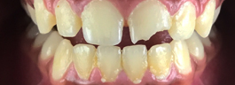 Crooked Tooth Correction - Before