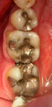 Ugly looking amalgam fillings