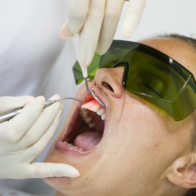 Laser Gums Treatment