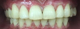 Laser Gums De Pigmentation - After