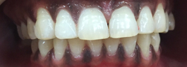 Laser Gums De Pigmentation - Before