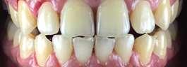 Teeth Whitening - Before