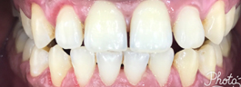 Teeth Whitening - After