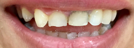 Mottling of Teeth Corrections - Before