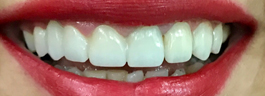 Mottling of Teeth Corrections - After