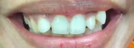 Gap Closure with Porcelain Veneers & Crowns - Before