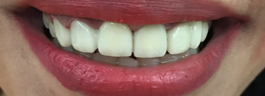 Gap Closure with Porcelain Veneers & Crowns - After