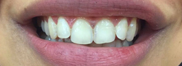 Gap Closure with Porcelain Veneers - Before