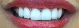 Gap Closure with Porcelain Veneers - After