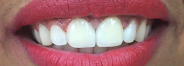 Gap Closure with Porcelain Veneers on Upper Centrals - After