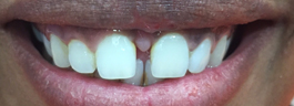 Gap Closure with Porcelain Veneers on Upper Centrals - Before