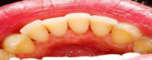 Scaling Polishing Teeth Cleaning - After