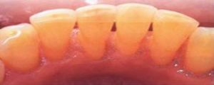 Scaling Polishing - Teeth Cleaning - After