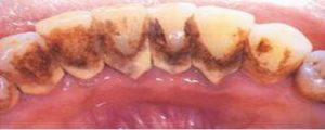 Scaling Polishing - Teeth Cleaning - Before