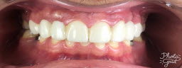 Smile Makeover with Metal Free E-Max Crowns - After