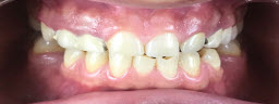 Smile Makeover with Metal Free E-Max Crowns - Before