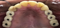 Upper Back Multiple Teeth Implants - After