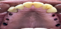 Upper Back Multiple Teeth Implants - Before