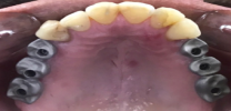 Upper Back Multiple Teeth Implants - Implant