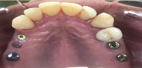 Upper Back Teeth Restored with Dental Implants and Screw Retained Crowns - Before