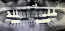 Upper Back Teeth Restored with Dental Implants and Screw Retained Crowns - Xray