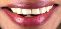 Upper Tooth Single Dental Implants After