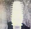 Upper Tooth Single Dental Implants Xray