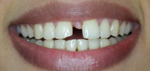 Gap Closure with Metal Free Crowns - Before