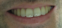 Zoom Teeth Whitening - Before