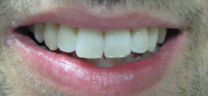 Zoom Teeth Whitening - After