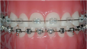 Braces (Metallic or Tooth Colored Ceramic)