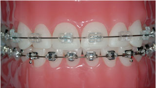 Orthodontics Treatment Case