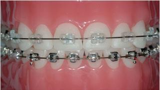 Braces Metallic Or Tooth Colored Ceramic