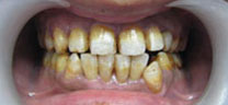 Cosmetic Dentistry - Before