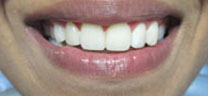 Cosmetic Dentistry - After