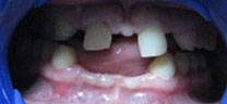 Cosmetic Dentistry - Before